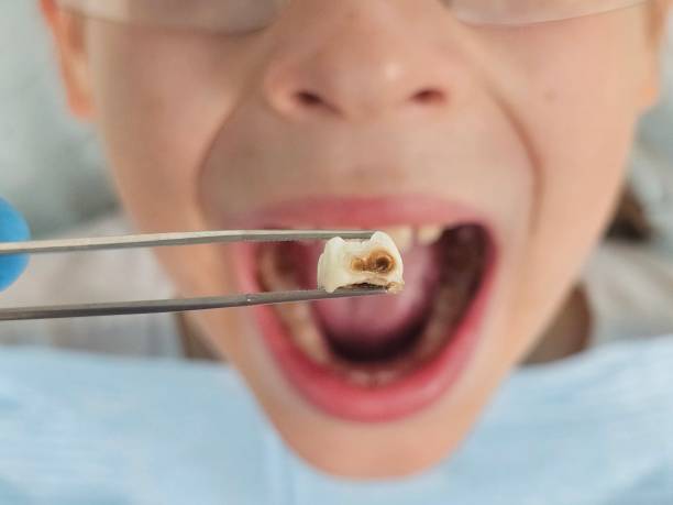Best Emergency Dental Care for Broken or Chipped Teeth in Brentwood, MO
